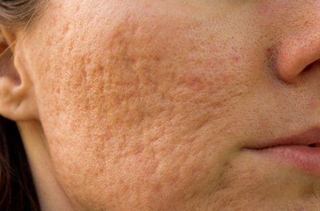 variabel Oceaan herfst Behandelingen tegen acné | Pro Skin Clinic te Meise